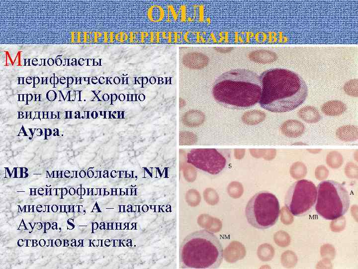 ОМЛ, ПЕРИФЕРИЧЕСКАЯ КРОВЬ Миелобласты периферической крови при ОМЛ. Хорошо видны палочки Ауэра. МВ –