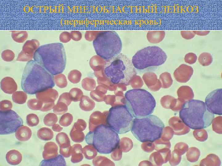 ОСТРЫЙ МИЕЛОБЛАСТНЫЙ ЛЕЙКОЗ (периферическая кровь) 