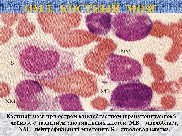ОМЛ, КОСТНЫЙ МОЗГ Костный мозг при остром миелобластном (гранулоцитарном) лейкозе с развитием анормальных клеток.