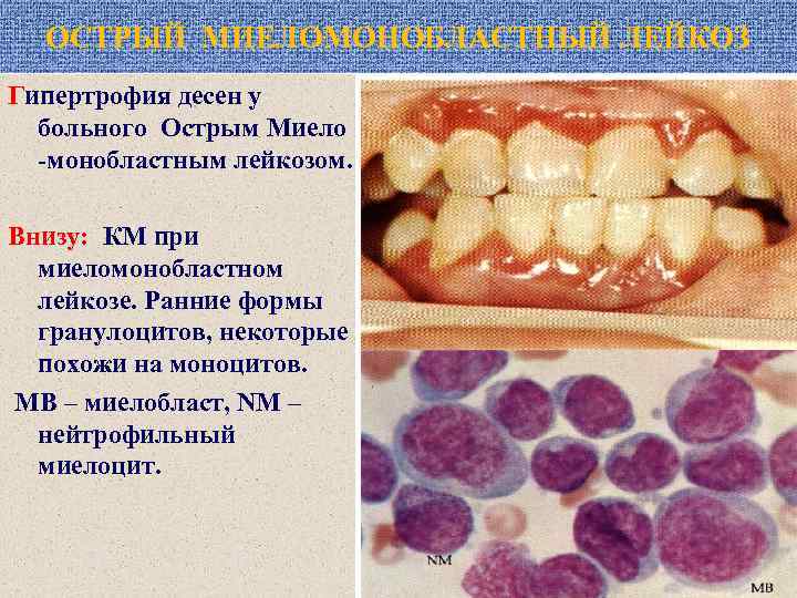 ОСТРЫЙ МИЕЛОМОНОБЛАСТНЫЙ ЛЕЙКОЗ Гипертрофия десен у больного Острым Миело -монобластным лейкозом. Внизу: КМ при