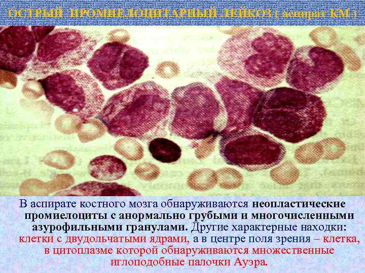 ОСТРЫЙ ПРОМИЕЛОЦИТАРНЫЙ ЛЕЙКОЗ ( аспират КМ ) В аспирате костного мозга обнаруживаются неопластические промиелоциты