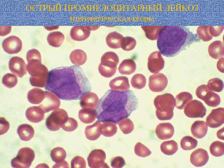 ОСТРЫЙ ПРОМИЕЛОЦИТАРНЫЙ ЛЕЙКОЗ (ПЕРИФЕРИЧЕСКАЯ КРОВЬ) 