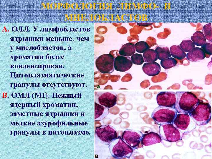 МОРФОЛОГИЯ ЛИМФО- И МИЕЛОБЛАСТОВ А. ОЛЛ. У лимфобластов ядрышки меньше, чем у миелобластов, а