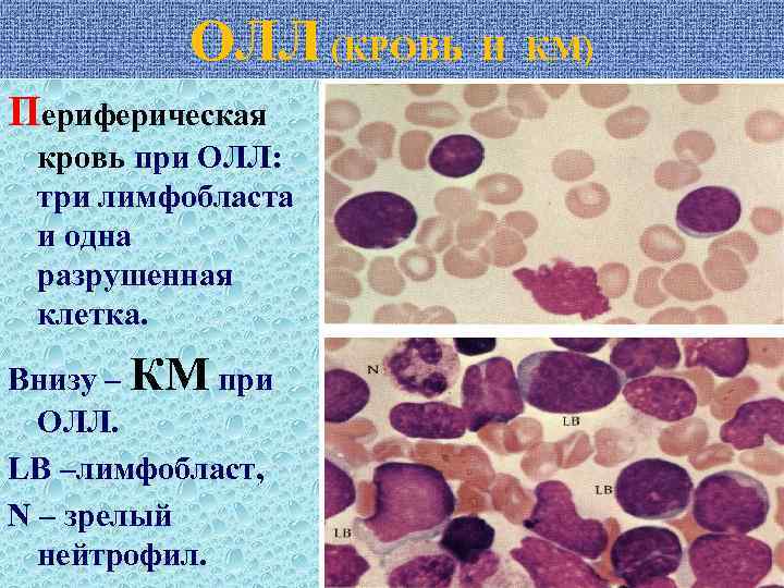 ОЛЛ (КРОВЬ И КМ) Периферическая кровь при ОЛЛ: три лимфобласта и одна разрушенная клетка.