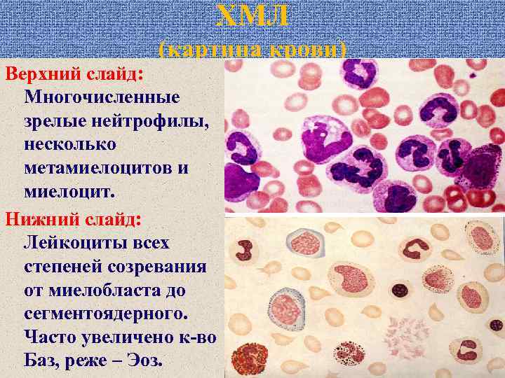 ХМЛ (картина крови) Верхний слайд: Многочисленные зрелые нейтрофилы, несколько метамиелоцитов и миелоцит. Нижний слайд: