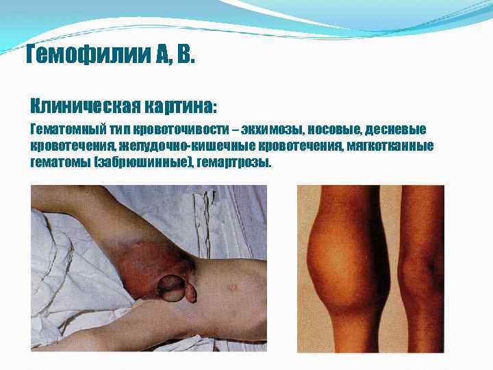 Гемофилии А, В. Клиническая картина: Гематомный тип кровоточивости – экхимозы, носовые, десневые кровотечения, желудочно-кишечные