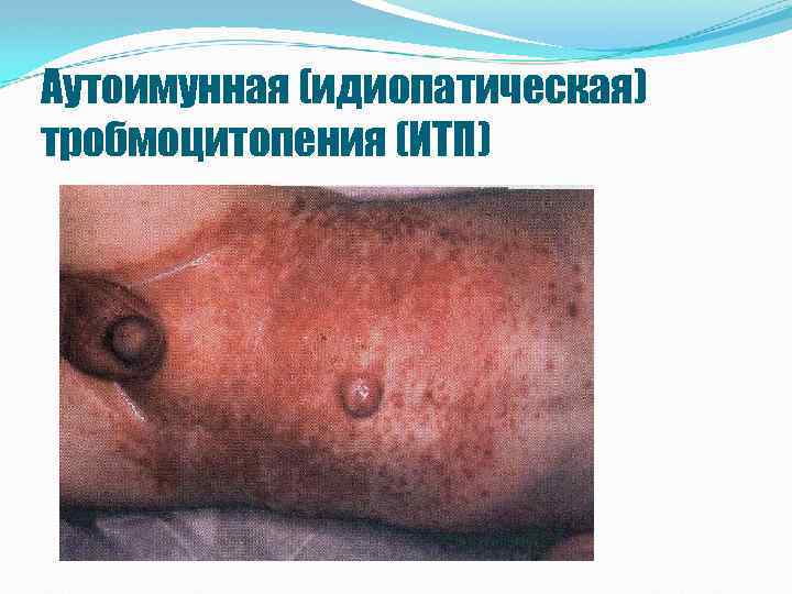 Аутоимунная (идиопатическая) тробмоцитопения (ИТП) 