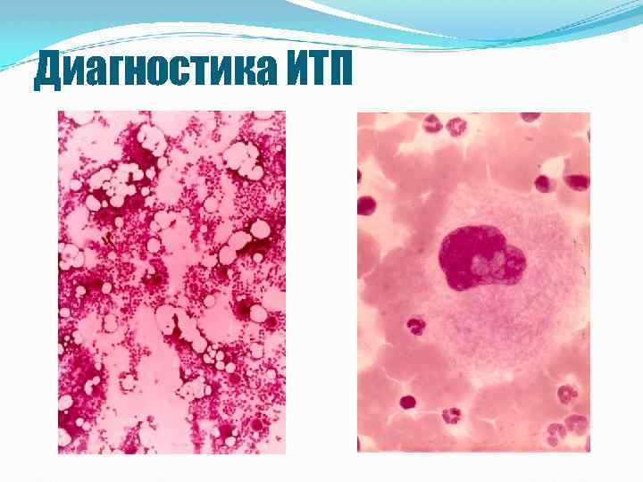 Диагностика ИТП 