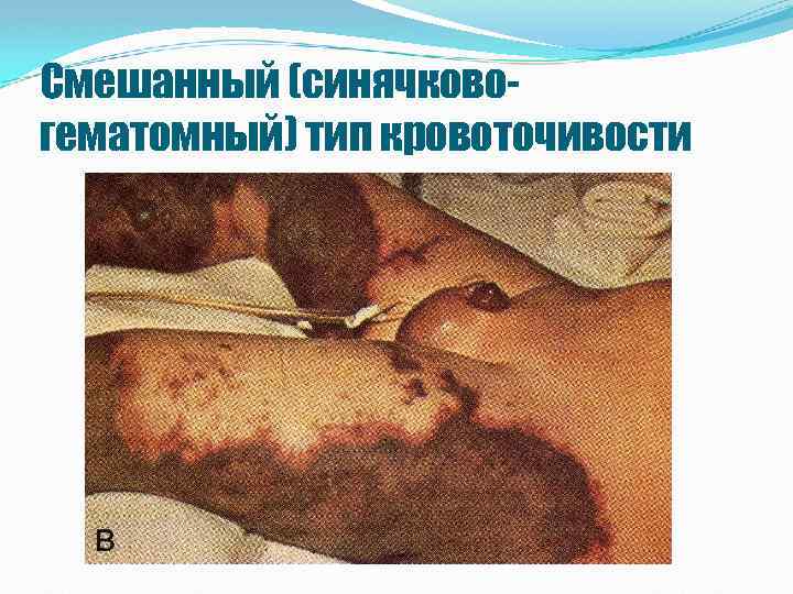 Смешанный (синячковогематомный) тип кровоточивости 