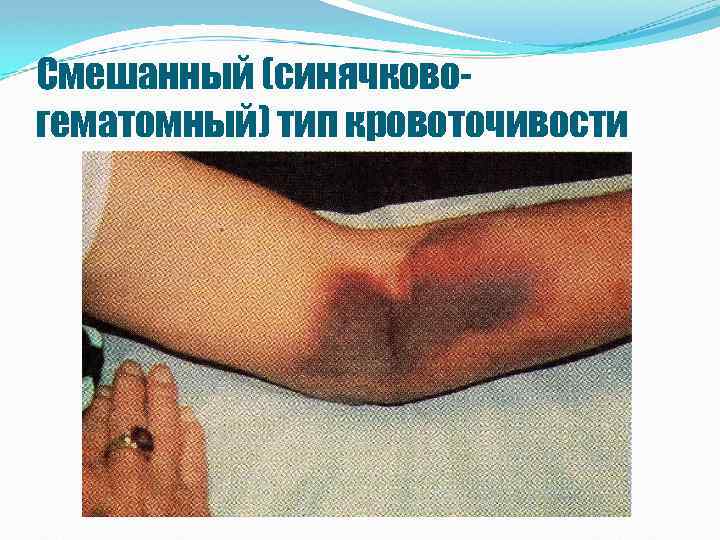 Смешанный (синячковогематомный) тип кровоточивости 
