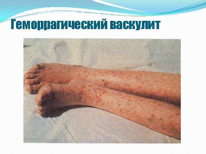 Геморрагический васкулит 