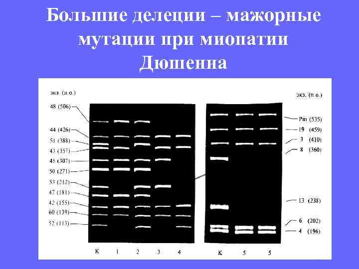Большие делеции – мажорные мутации при миопатии Дюшенна 