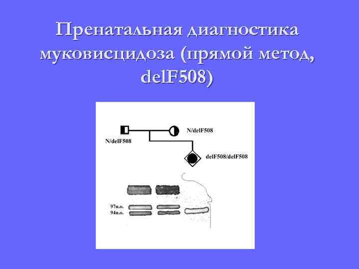 Пренатальная диагностика муковисцидоза (прямой метод, del. F 508) 