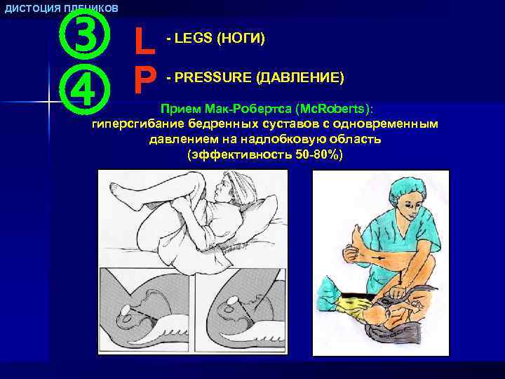  L P ДИСТОЦИЯ ПЛЕЧИКОВ - LEGS (НОГИ) - PRESSURE (ДАВЛЕНИЕ) Прием Мак-Робертса (Mc.