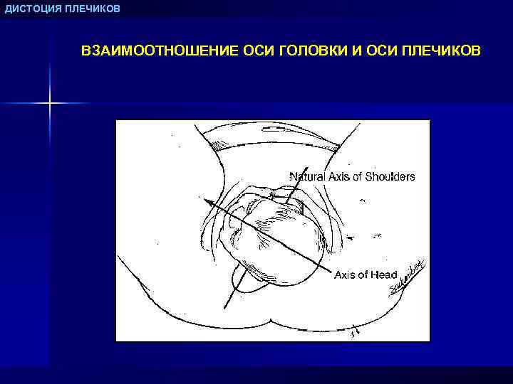 ДИСТОЦИЯ ПЛЕЧИКОВ ВЗАИМООТНОШЕНИЕ ОСИ ГОЛОВКИ И ОСИ ПЛЕЧИКОВ 