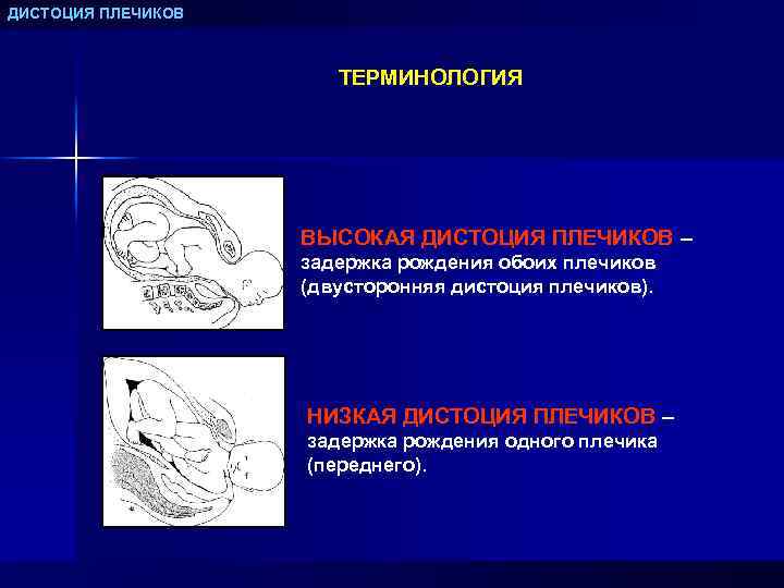 ДИСТОЦИЯ ПЛЕЧИКОВ ТЕРМИНОЛОГИЯ ВЫСОКАЯ ДИСТОЦИЯ ПЛЕЧИКОВ – задержка рождения обоих плечиков (двусторонняя дистоция плечиков).