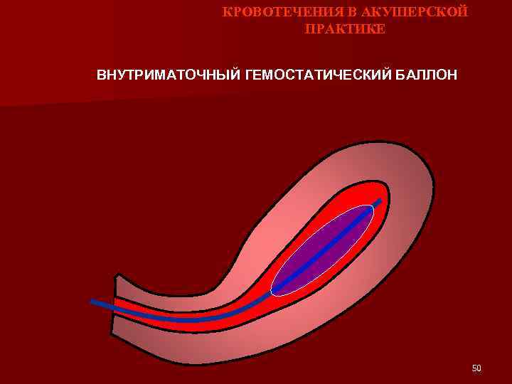 КРОВОТЕЧЕНИЯ В АКУШЕРСКОЙ ПРАКТИКЕ ВНУТРИМАТОЧНЫЙ ГЕМОСТАТИЧЕСКИЙ БАЛЛОН 50 