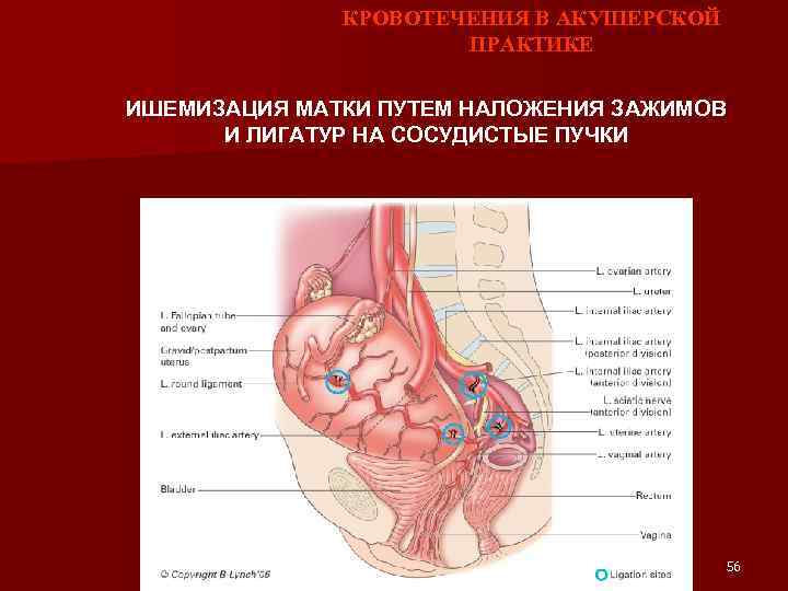 КРОВОТЕЧЕНИЯ В АКУШЕРСКОЙ ПРАКТИКЕ ИШЕМИЗАЦИЯ МАТКИ ПУТЕМ НАЛОЖЕНИЯ ЗАЖИМОВ И ЛИГАТУР НА СОСУДИСТЫЕ ПУЧКИ