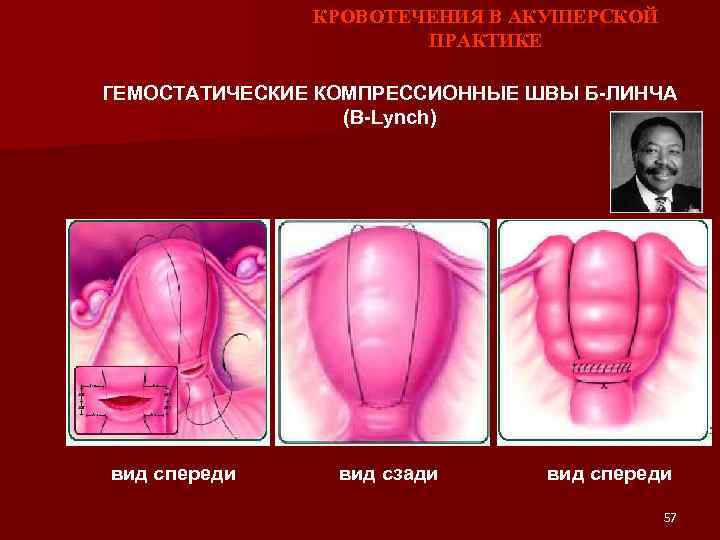 КРОВОТЕЧЕНИЯ В АКУШЕРСКОЙ ПРАКТИКЕ ГЕМОСТАТИЧЕСКИЕ КОМПРЕССИОННЫЕ ШВЫ Б-ЛИНЧА (B-Lynch) вид спереди вид сзади вид