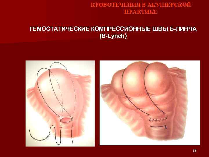 КРОВОТЕЧЕНИЯ В АКУШЕРСКОЙ ПРАКТИКЕ ГЕМОСТАТИЧЕСКИЕ КОМПРЕССИОННЫЕ ШВЫ Б-ЛИНЧА (B-Lynch) 58 