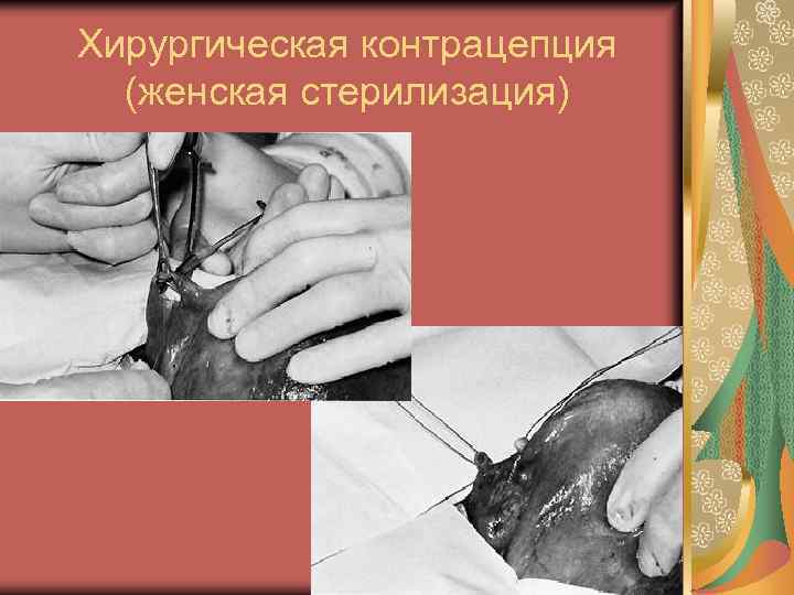 Хирургическая контрацепция (женская стерилизация) 