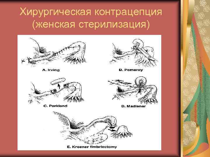 Хирургическая контрацепция (женская стерилизация) 