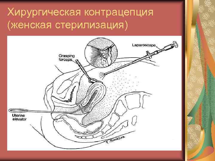 Хирургическая контрацепция (женская стерилизация) 