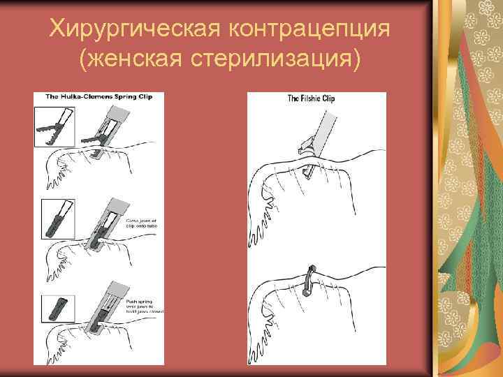 Хирургическая контрацепция (женская стерилизация) 