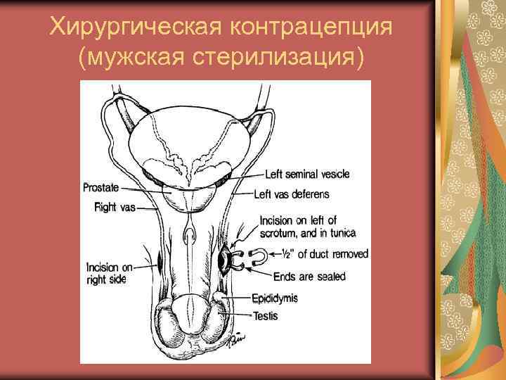 Хирургическая контрацепция (мужская стерилизация) 