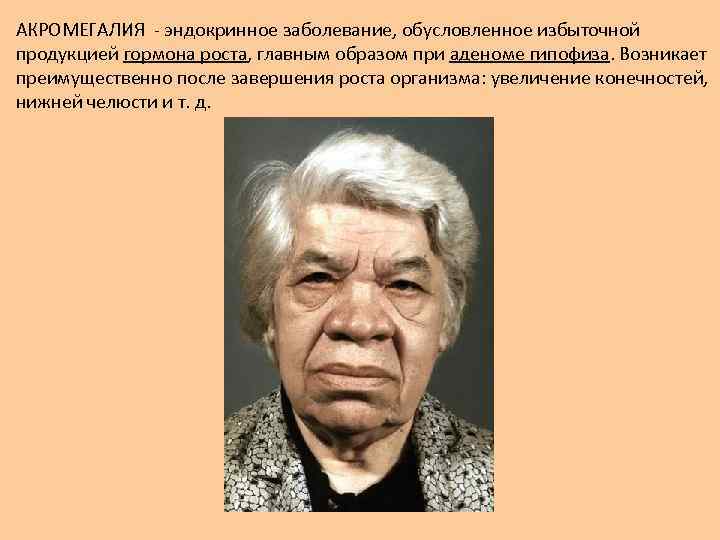 АКРОМЕГАЛИЯ - эндокринное заболевание, обусловленное избыточной продукцией гормона роста, главным образом при аденоме гипофиза.