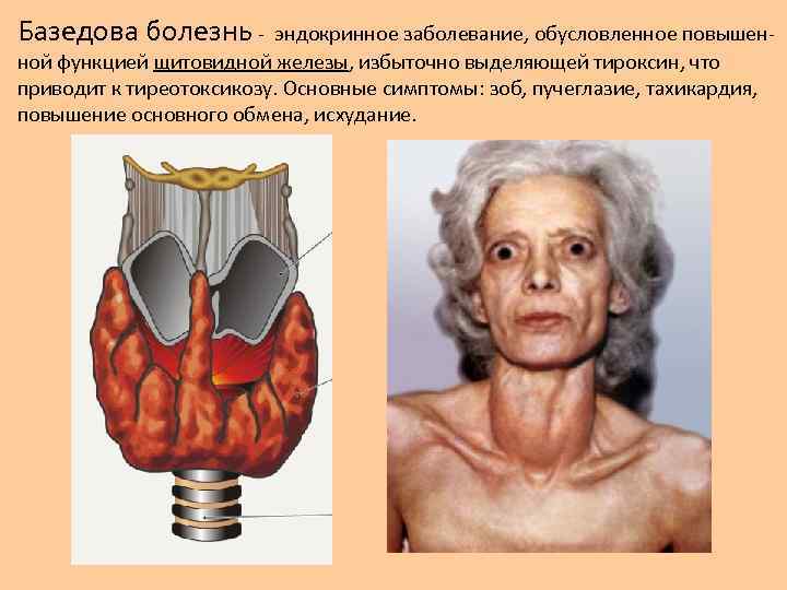 Базедова болезнь - эндокринное заболевание, обусловленное повышенной функцией щитовидной железы, избыточно выделяющей тироксин, что