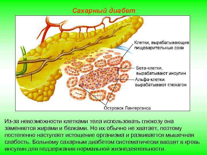Сахарный диабет Из-за невозможности клетками тела использовать глюкозу она заменяется жирами и белками. Но