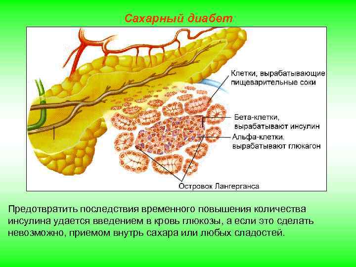 Сахарный диабет Предотвратить последствия временного повышения количества инсулина удается введением в кровь глюкозы, а