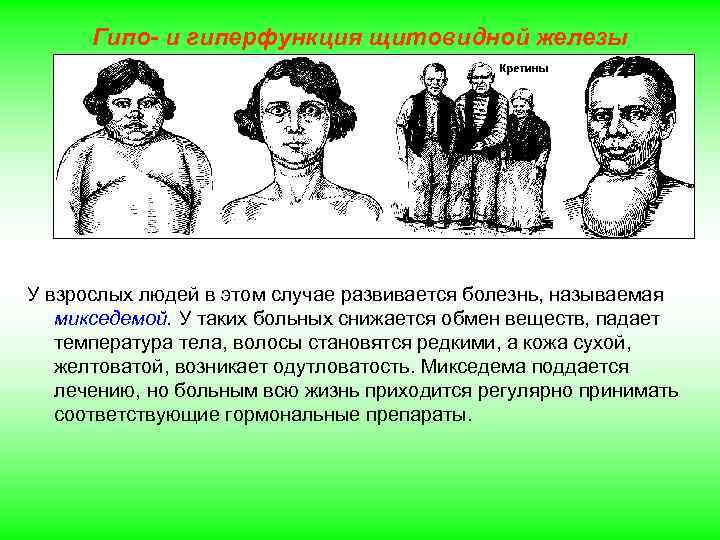 Гипо- и гиперфункция щитовидной железы У взрослых людей в этом случае развивается болезнь, называемая