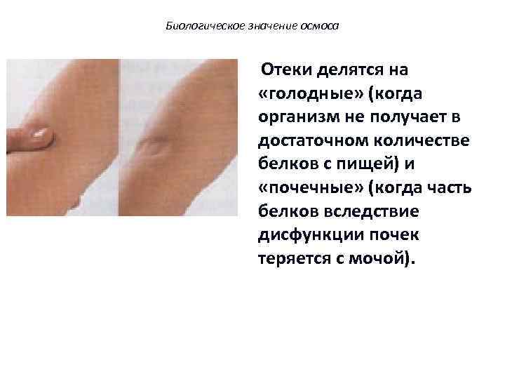 Биологическое значение осмоса Отеки делятся на «голодные» (когда организм не получает в достаточном количестве
