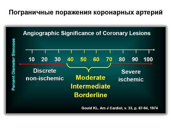 Пограничные поражения коронарных артерий 