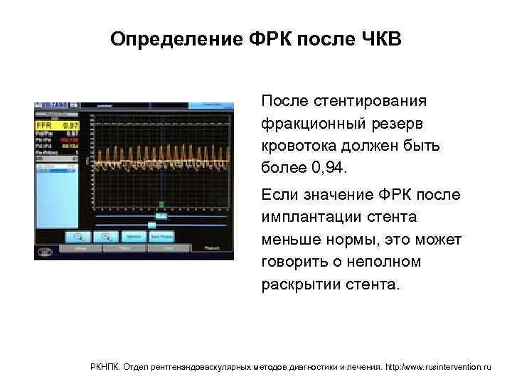 Определение ФРК после ЧКВ После стентирования фракционный резерв кровотока должен быть более 0, 94.