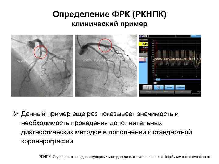 Определение ФРК (РКНПК) клинический пример Ø Данный пример еще раз показывает значимость и необходимость