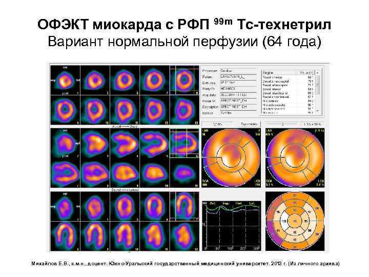 ОФЭКТ миокарда с РФП 99 m Tc-технетрил Вариант нормальной перфузии (64 года) Михайлов Е.