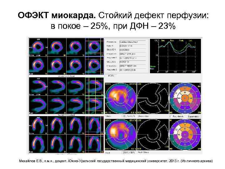 ОФЭКТ миокарда. Стойкий дефект перфузии: в покое – 25%, при ДФН – 23% Михайлов