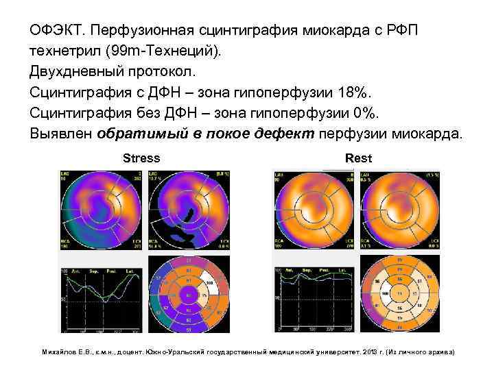 ОФЭКТ. Перфузионная сцинтиграфия миокарда с РФП технетрил (99 m-Технеций). Двухдневный протокол. Сцинтиграфия с ДФН