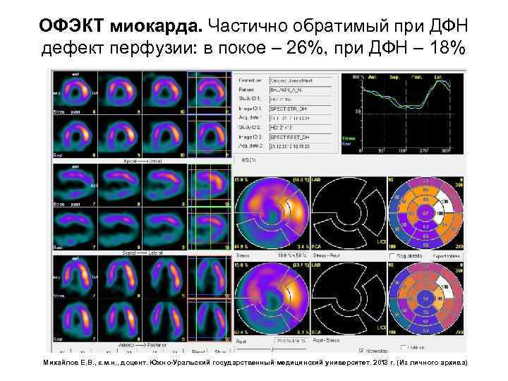 ОФЭКТ миокарда. Частично обратимый при ДФН дефект перфузии: в покое – 26%, при ДФН