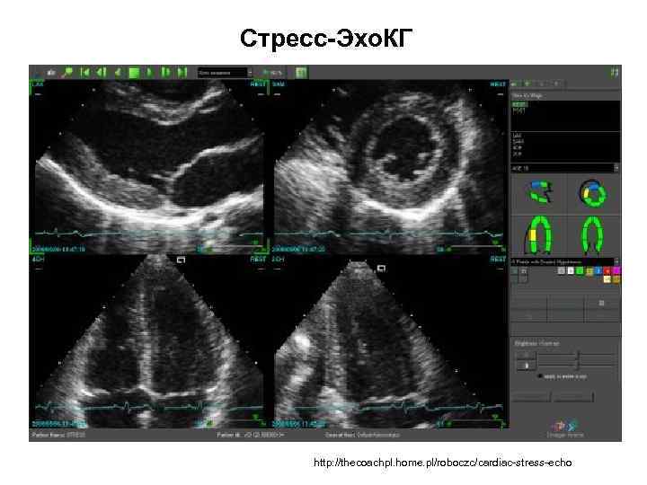Стресс эхокг презентация