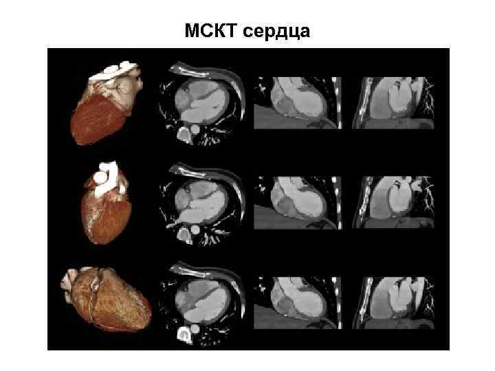 МСКТ сердца 
