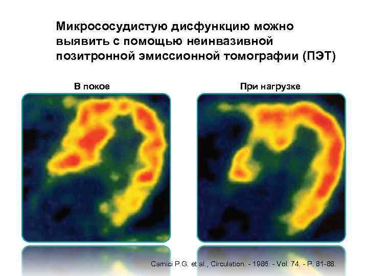 Микрососудистую дисфункцию можно выявить с помощью неинвазивной позитронной эмиссионной томографии (ПЭТ) В покое При