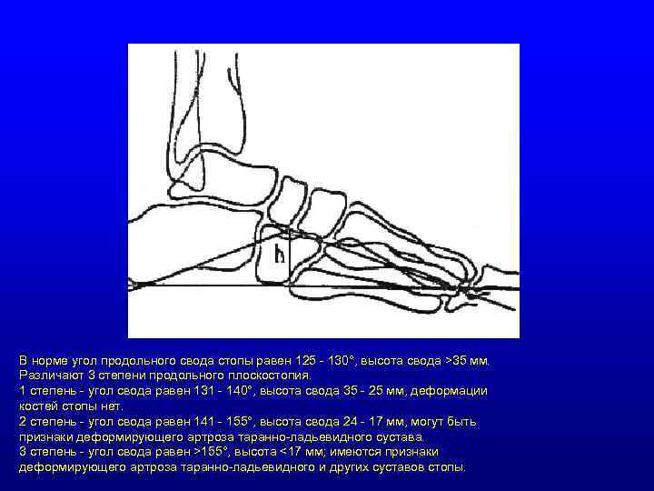В норме угол продольного свода стопы равен 125 - 130°, высота свода >35 мм.