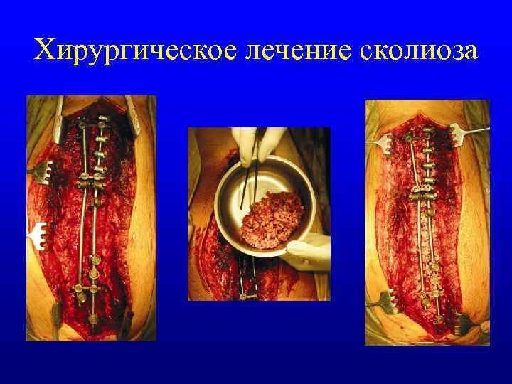 Хирургическое лечение сколиоза 