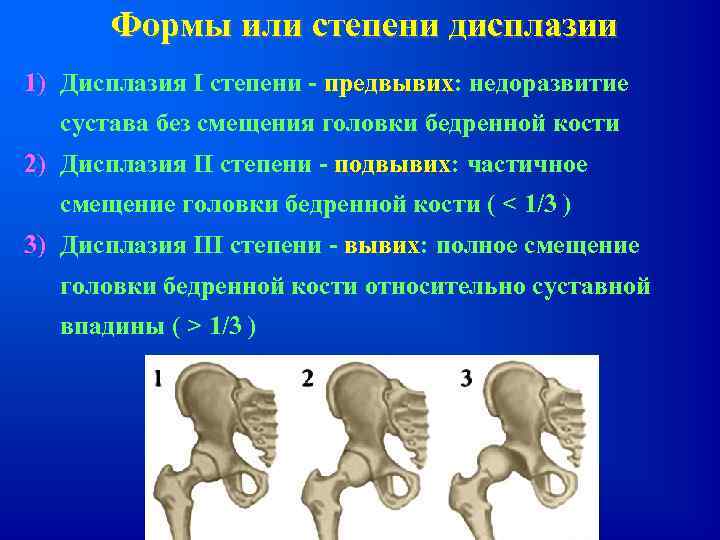 Формы или степени дисплазии 1) Дисплазия I степени - предвывих: недоразвитие сустава без смещения