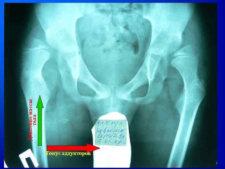 Тонус аддукторов Давление массы тела 