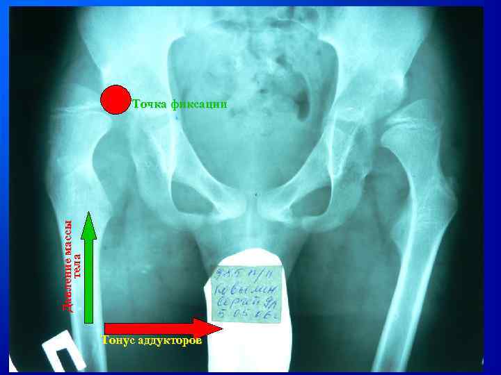Давление массы тела Точка фиксации Тонус аддукторов 